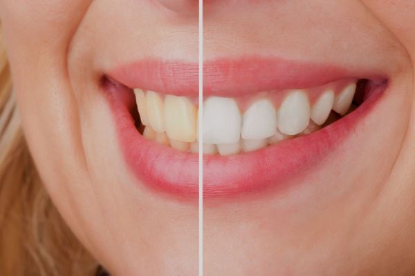 Teeth whitening before and after