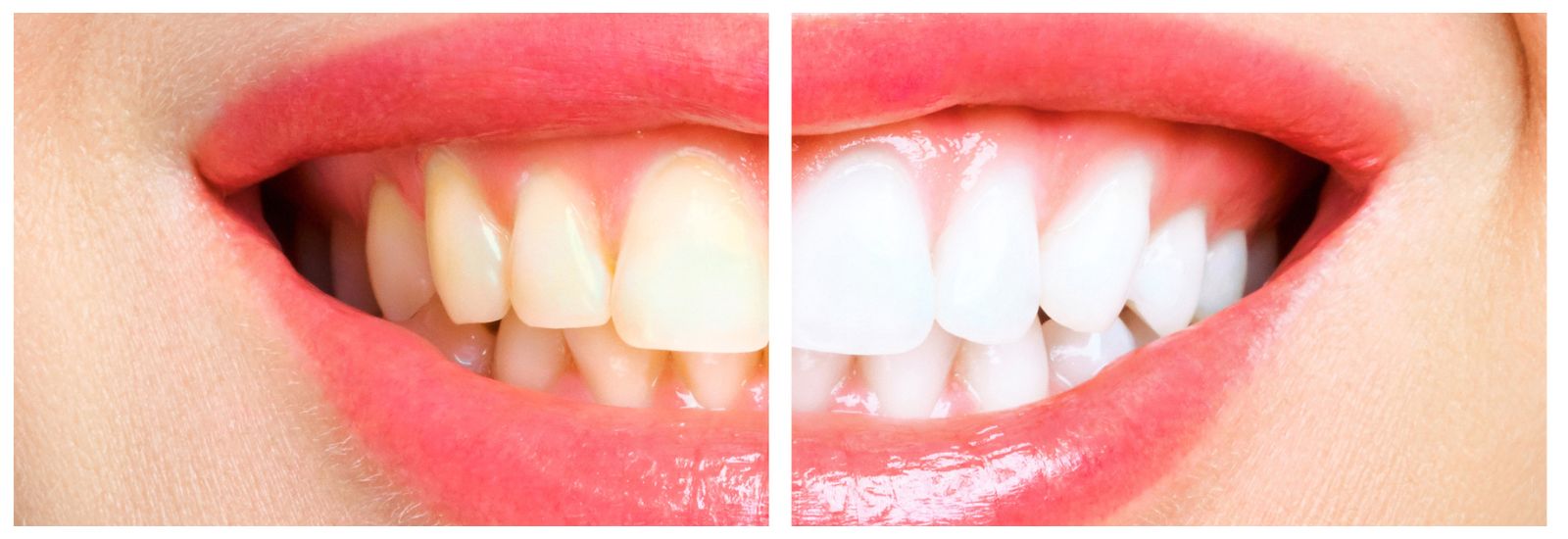 Teeth whitening color comparison