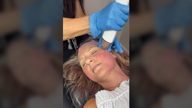 RF Microneedling Procedure Video